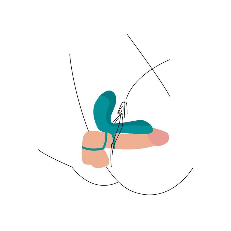 Schema d'utilisation illustrant l'anneau vibrant couple turquoise mis en place, dessin de position avec extension clitoridienne positionnee pour le couple.